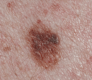Atypical Moles - The Skin Cancer Foundation