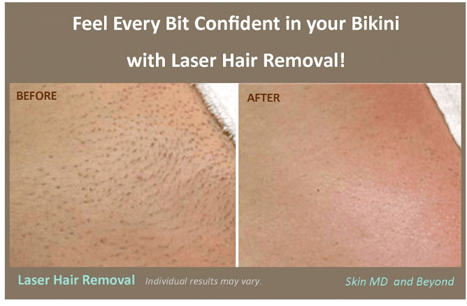 Laser Bikini (Brazilian) Hair Removal: Procedure, Cost & Results