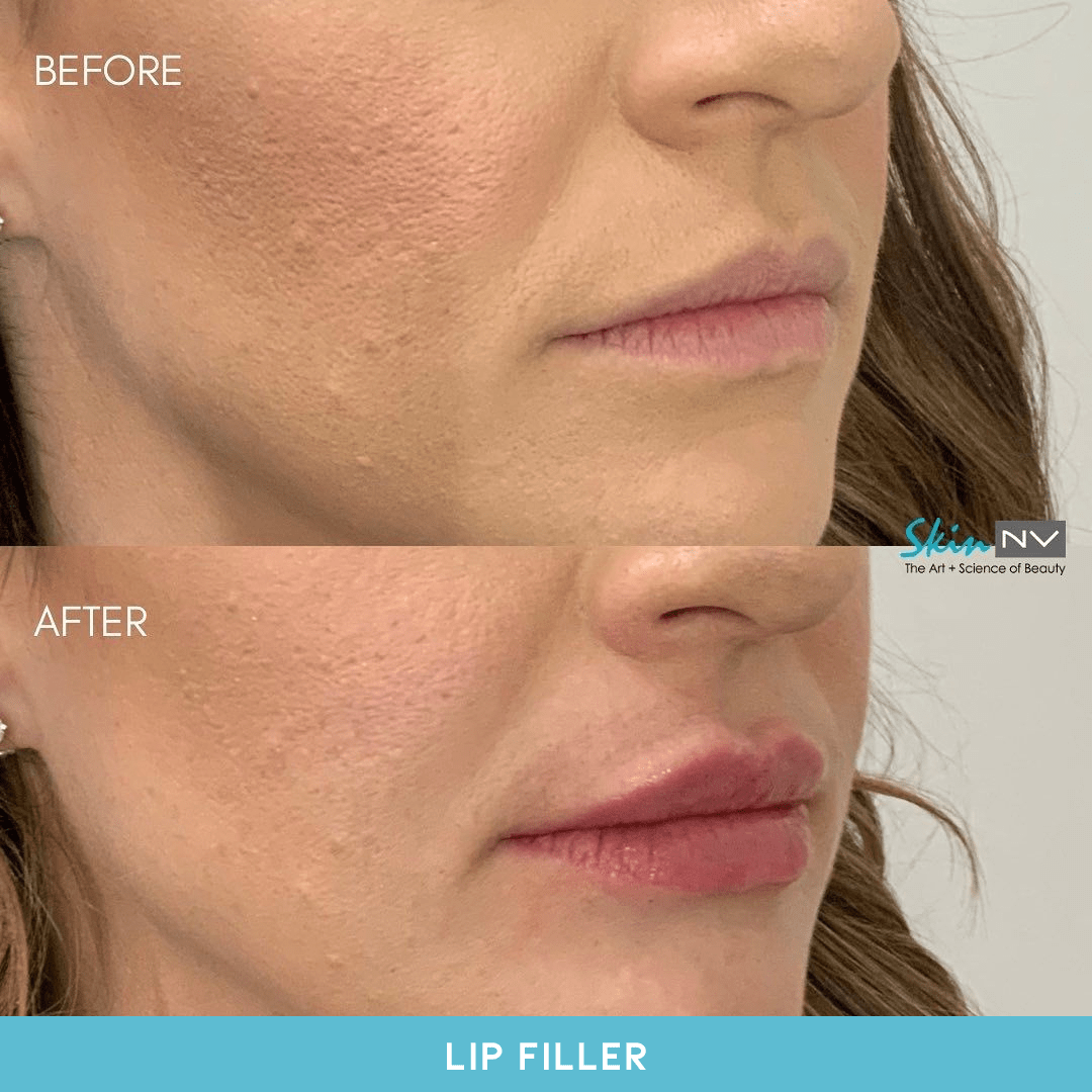 Before & After Gallery Tampa Fillers, Botox, Lasers & More Skin NV