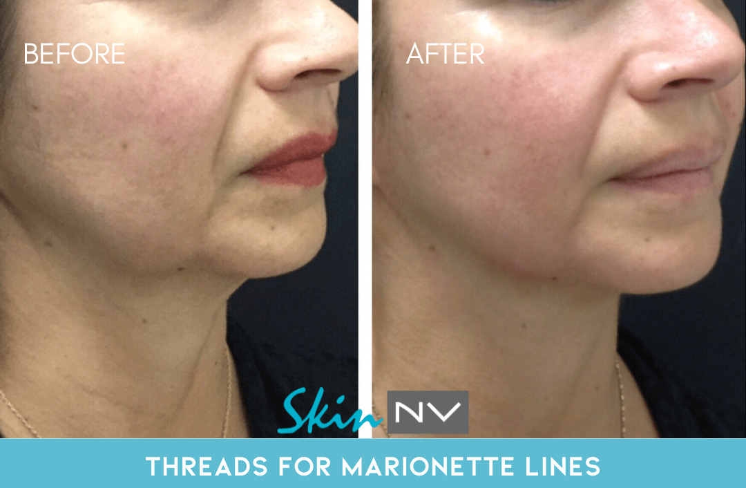 Before & After Gallery | Tampa Fillers, Botox, Lasers & More | Skin NV