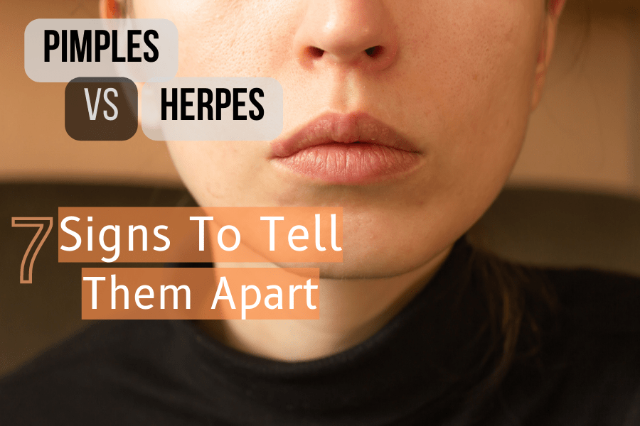 Pimples Vs. Herpes7 Signs To Tell Them Apart
