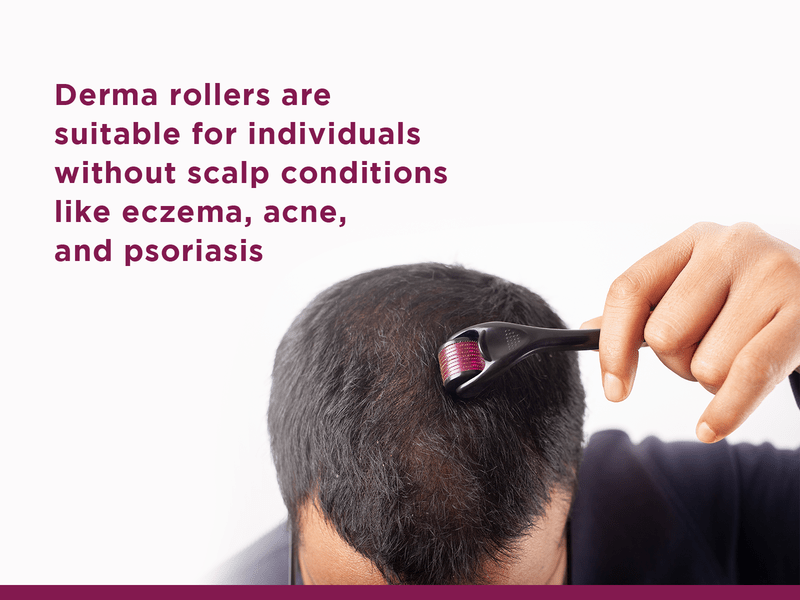 The Benefits of Using a Derma Roller for Hair Loss Skin Solutionz