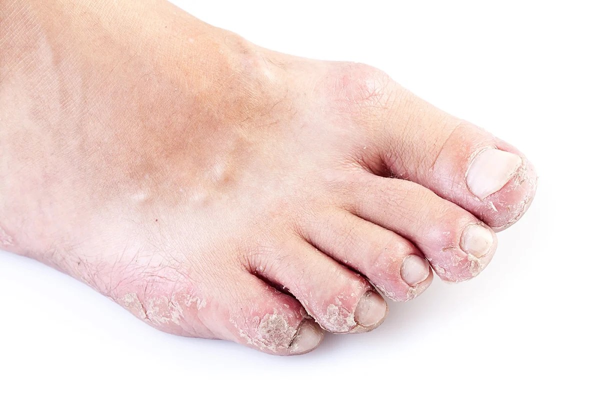 Eczema (Atopic Dermatitis) Symptoms, Causes, Treatment and Photos