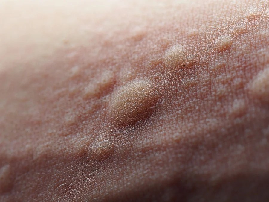 Hives (Urticaria) Symptoms, Causes, Treatment and Photos
