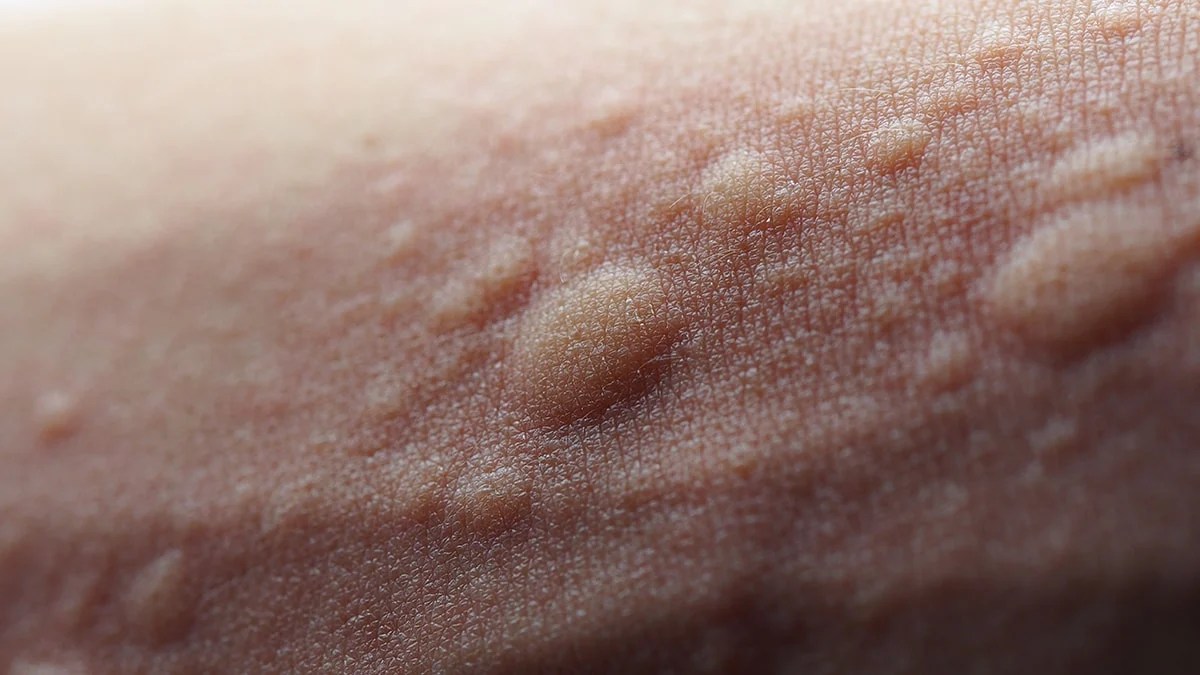 Hives Swelling Urticaria Welts Causes Symptoms Treatment Images