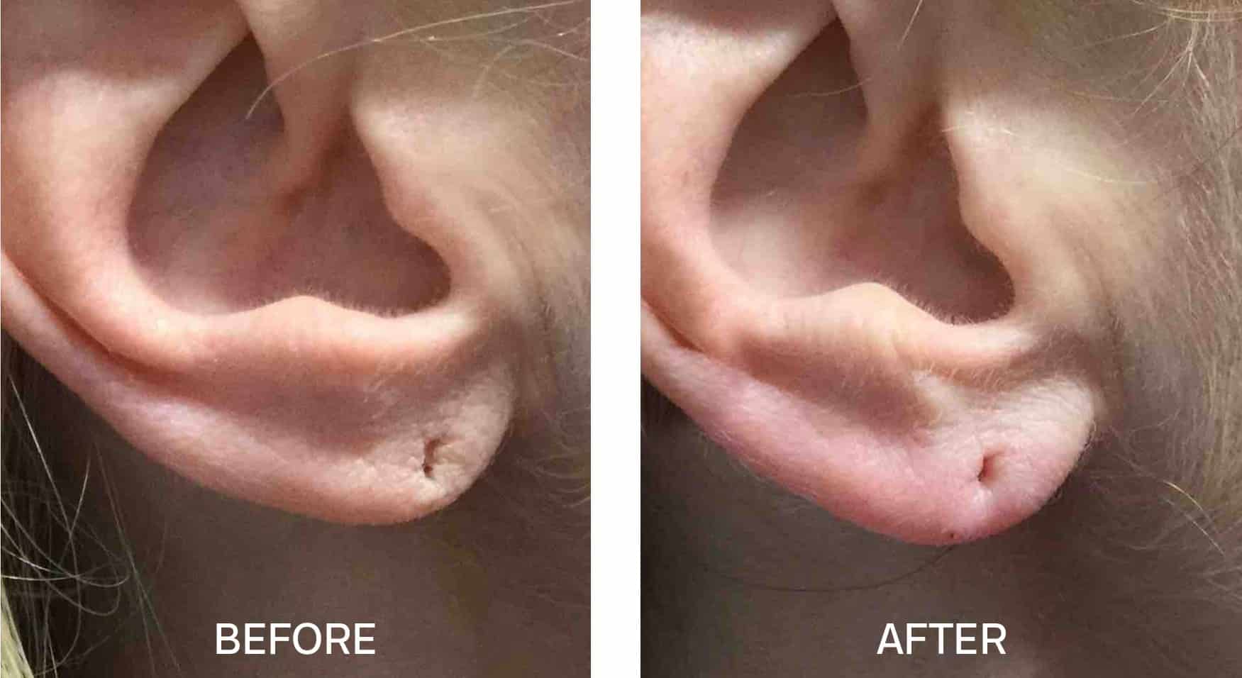 Earlobe Repair Toronto Fix Earlobe Richmond Earlobe Rejuvenation