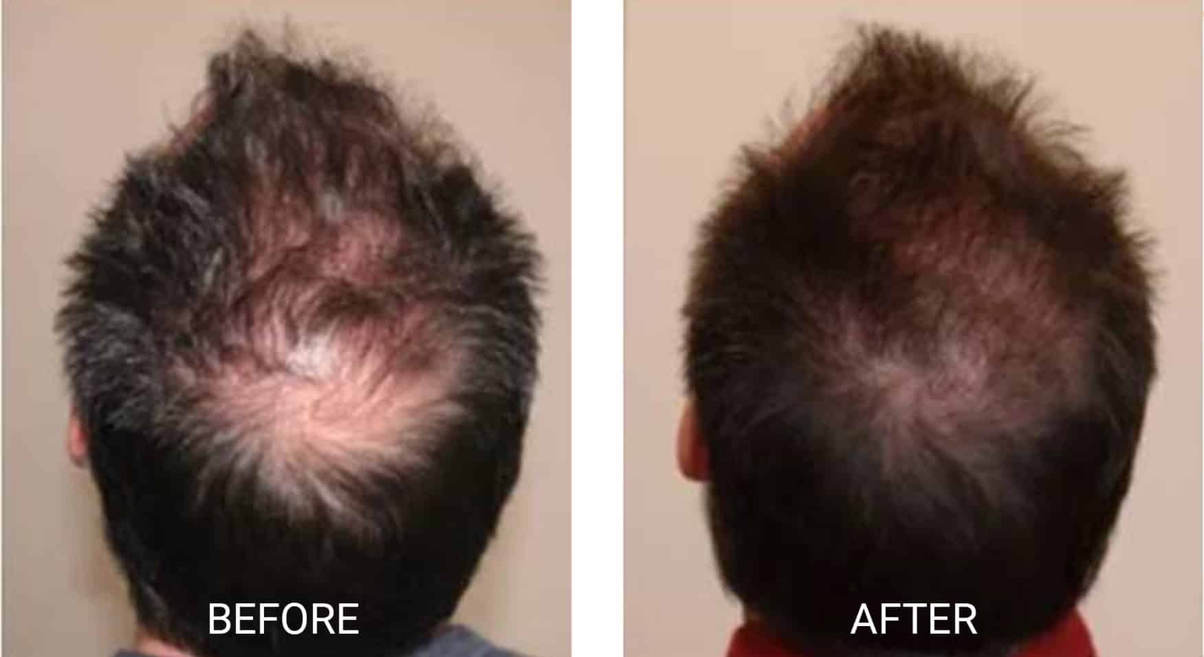 PRP Hair Treatment Milton PRP Near Me PRP Cost Milton