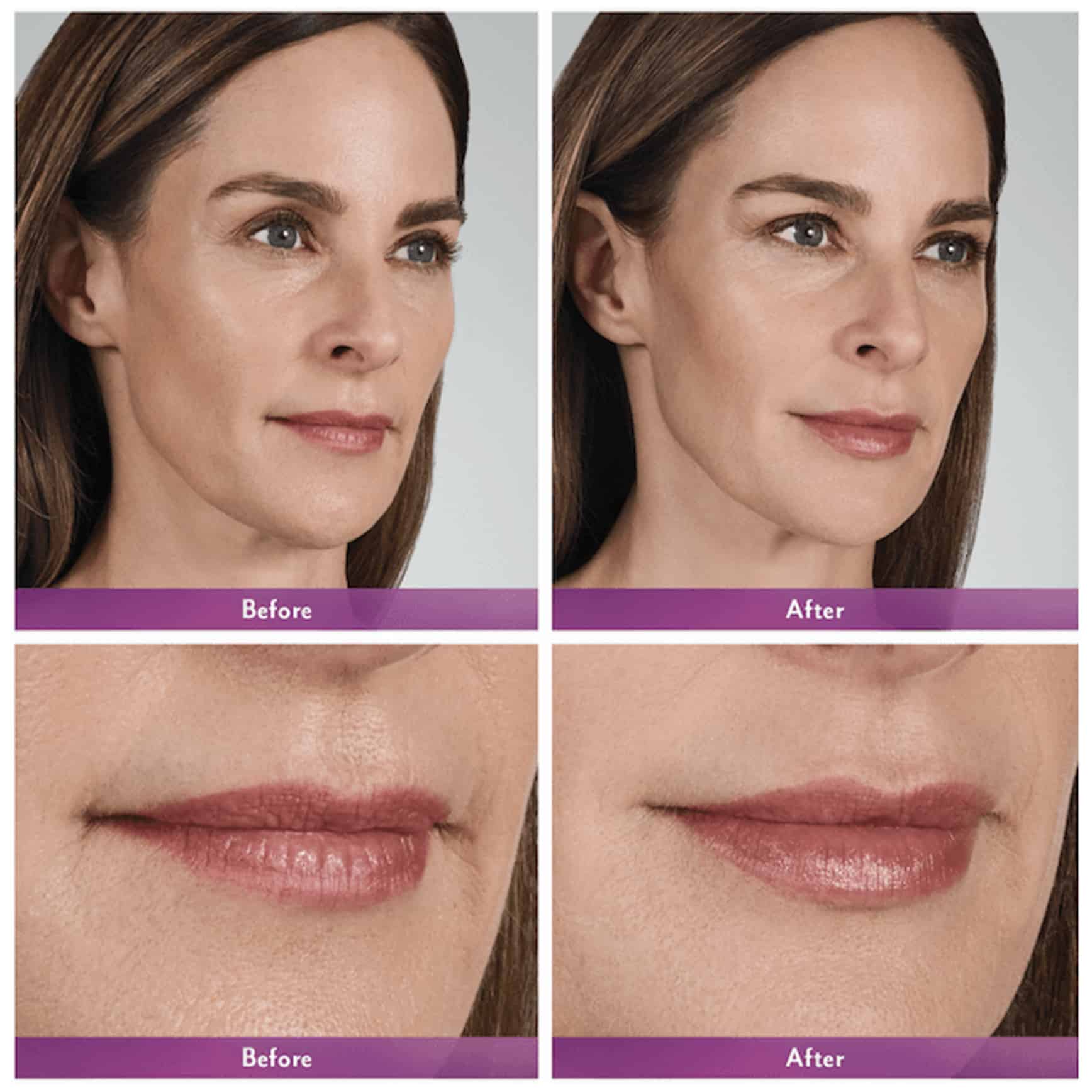 Lip Fillers Toronto Juvederm Fillers Toronto Lip Fillers Near Me