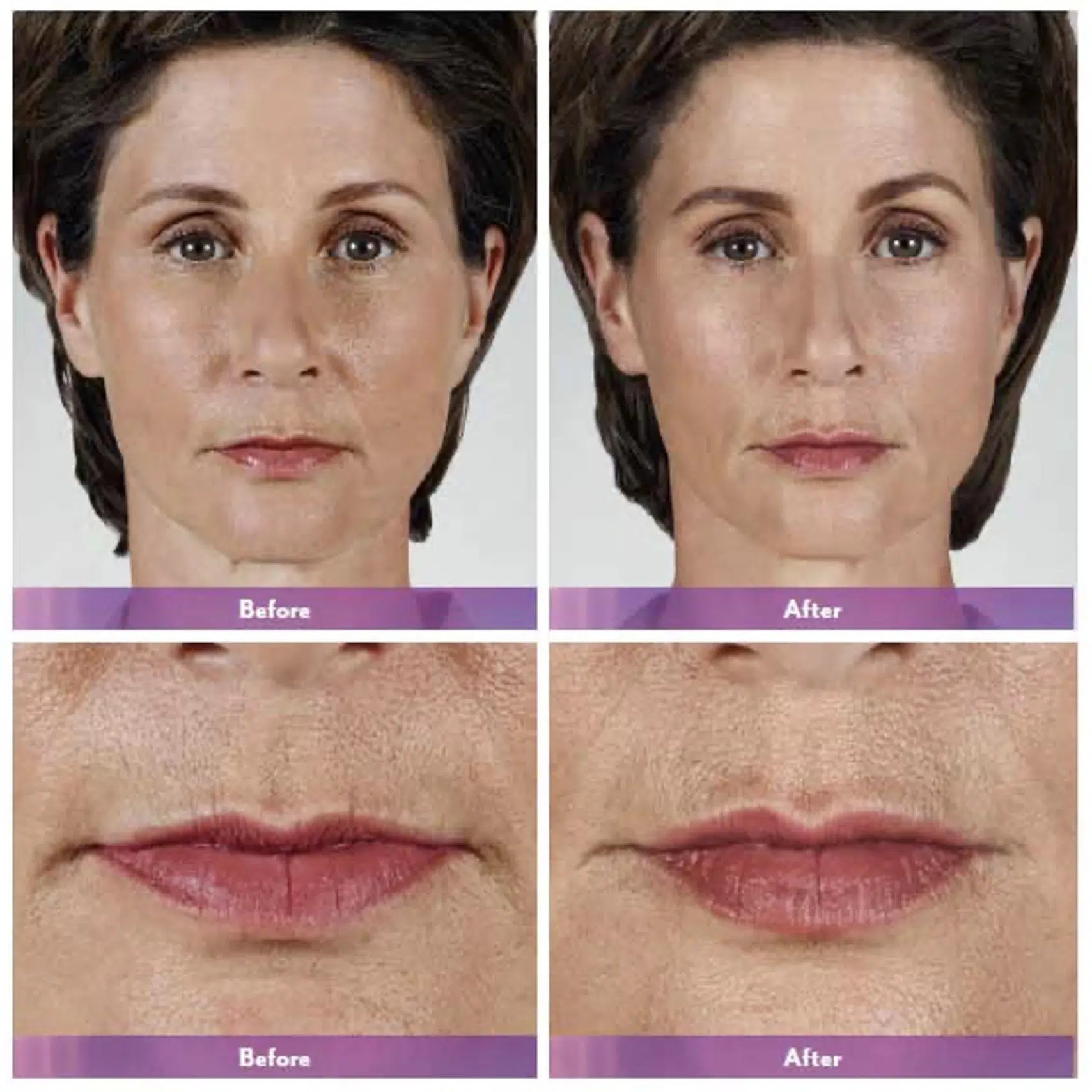 Lip Fillers Toronto Juvederm Fillers Toronto Lip Fillers Near Me