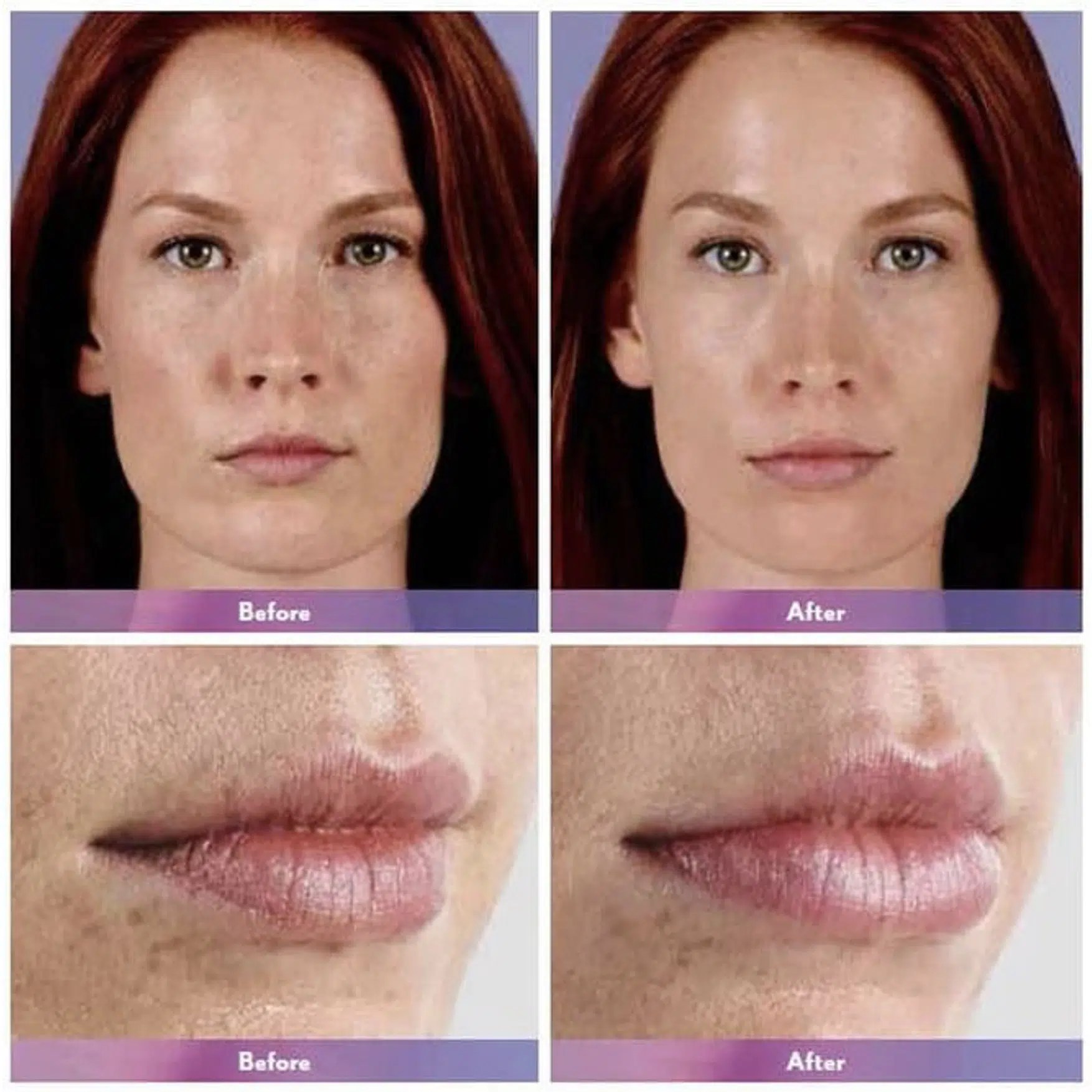Teosyal vs Juvederm Difference Teoxane Filler vs Juvederm Filler