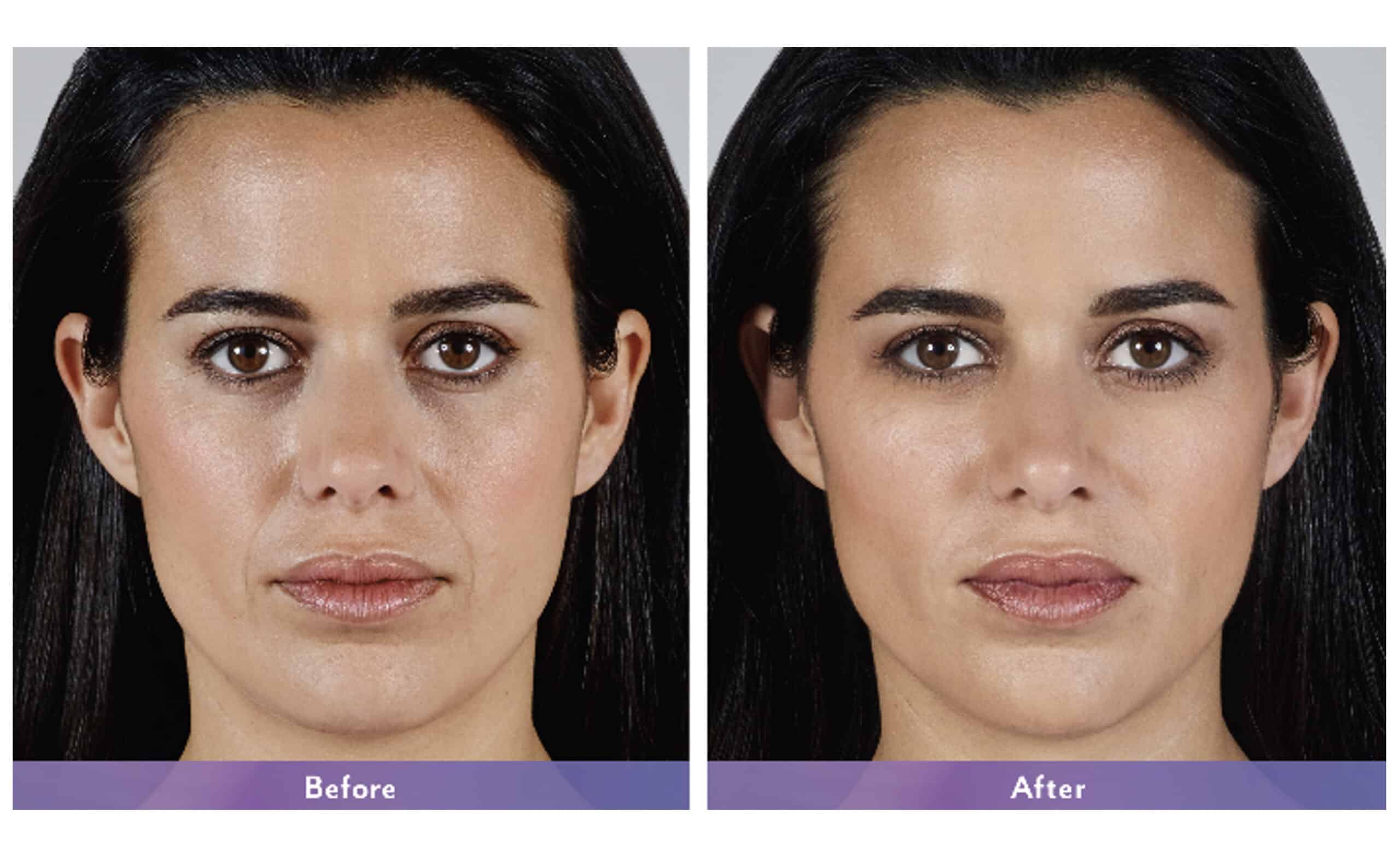 Cheek Fillers Toronto Cheek Filler Cost Toronto Fillers Toronto