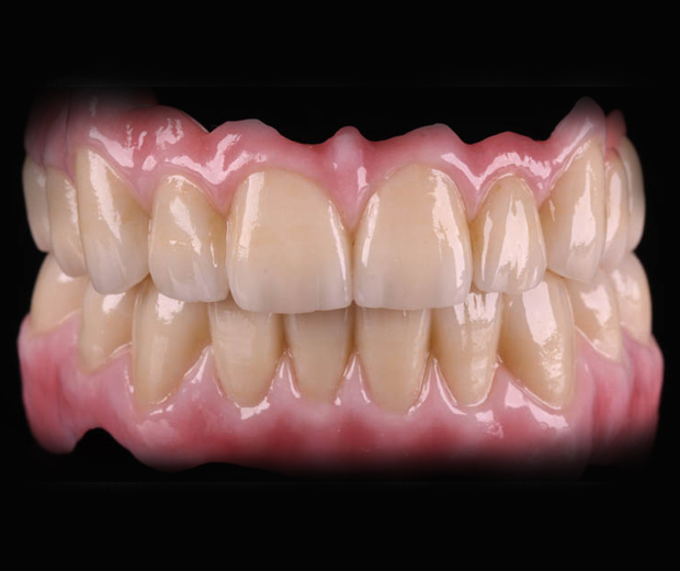 Implant Restoration