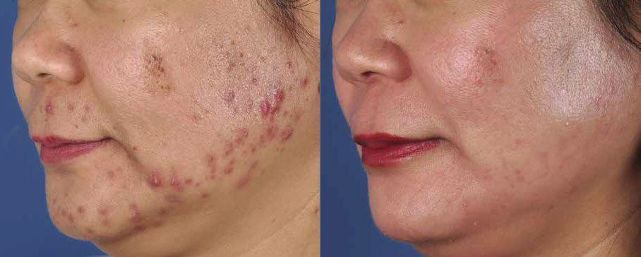 Photodynamic Therapy Schaumburg Chicago Illinois Skypoint Medical