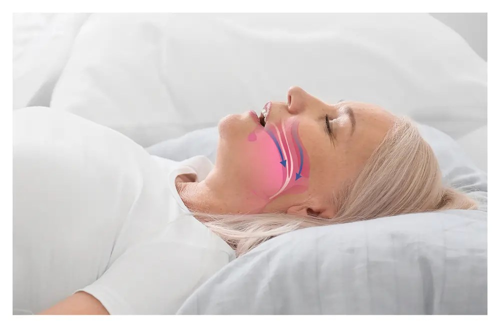 Sleep Apnea Everything You Need to Know Sleep Authority