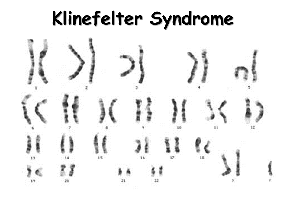 Turner syndrome Wikipedia