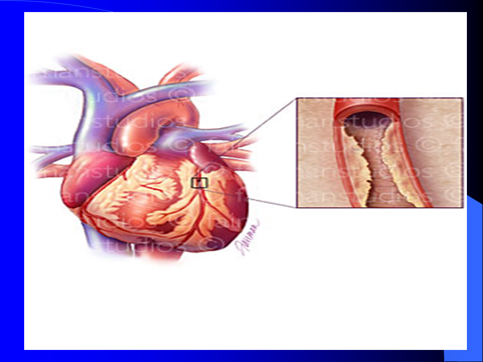 Atherosclerosis This is where too much cholesterol has