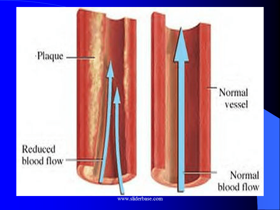 Atherosclerosis This is where too much cholesterol has