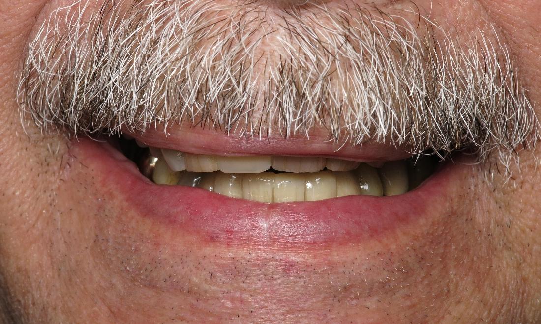 Fixing Teeth From Severe Damage Before & After Dental Bridges 70605