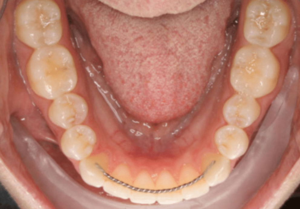 PostOp Instructions Orthodontic Retainers