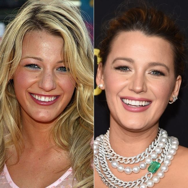 Do All Celebrities Have Veneers? Your Personal Guide on Hollywood Smile