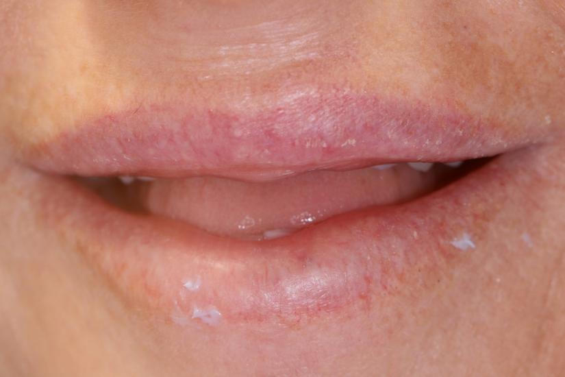White Spots On Lips Hpv
