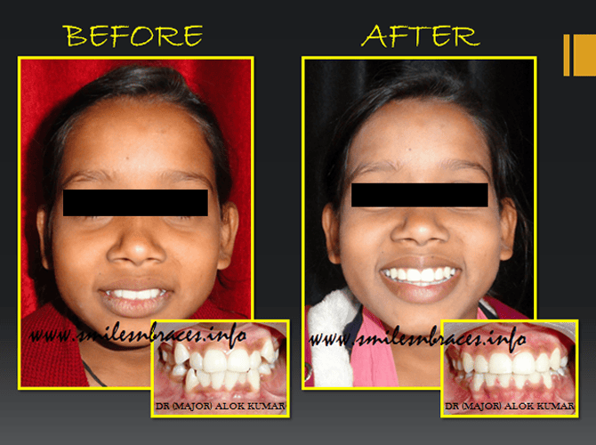 Crowding Treated By All First Premolar Extraction SmilesNBraces
