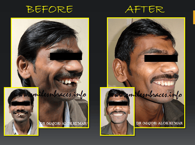Severe Crowding Treated By All First Premolar Extraction SmilesNBraces