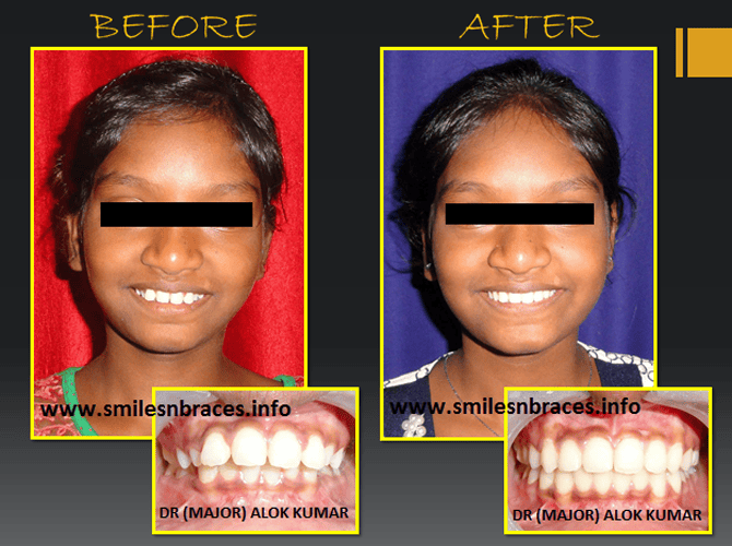 Crowding Treated By All First Premolar Extraction SmilesNBraces