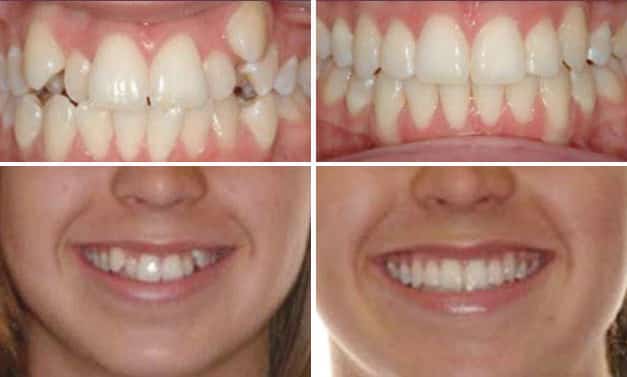 Invisalign Before & Afters Invisalign No Braces Smile Solutions