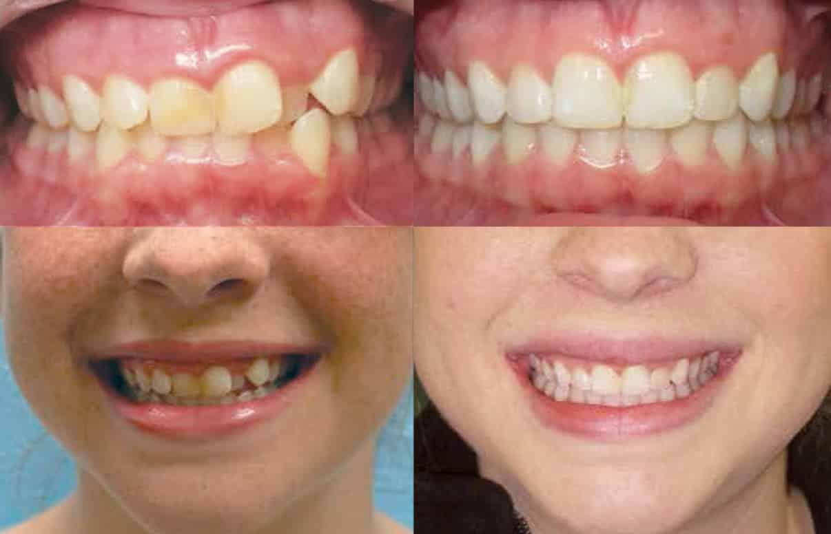Invisalign Melbourne Invisalign Orthodontists Smile Solutions®