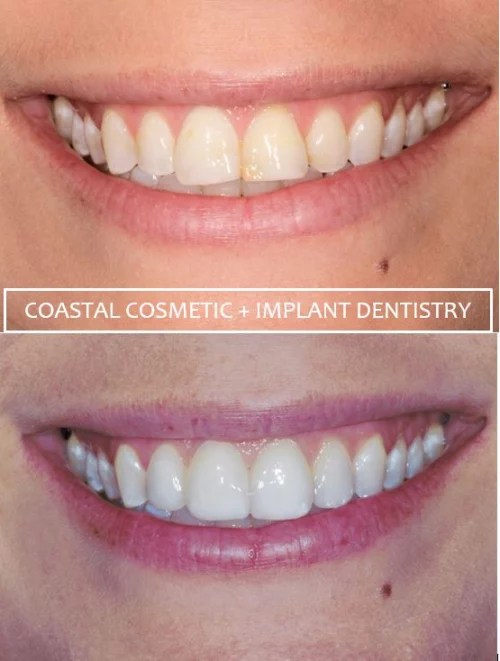 Cosmetic Dentistry Before And After Photos Virginia Beach