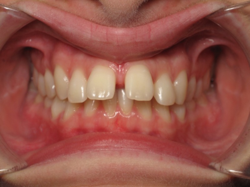 Orthodontic Before & Afters Chapel Hill Braces Mebane Orthodontics