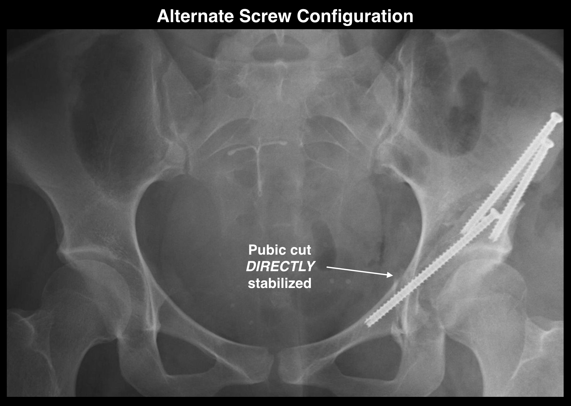 Bony Stability following PAO Surgery North Hollywood Los Angeles