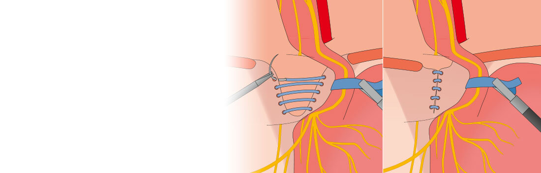 BicornVerfahren ZwerchfellbruchOperation Reflux Zentrum München