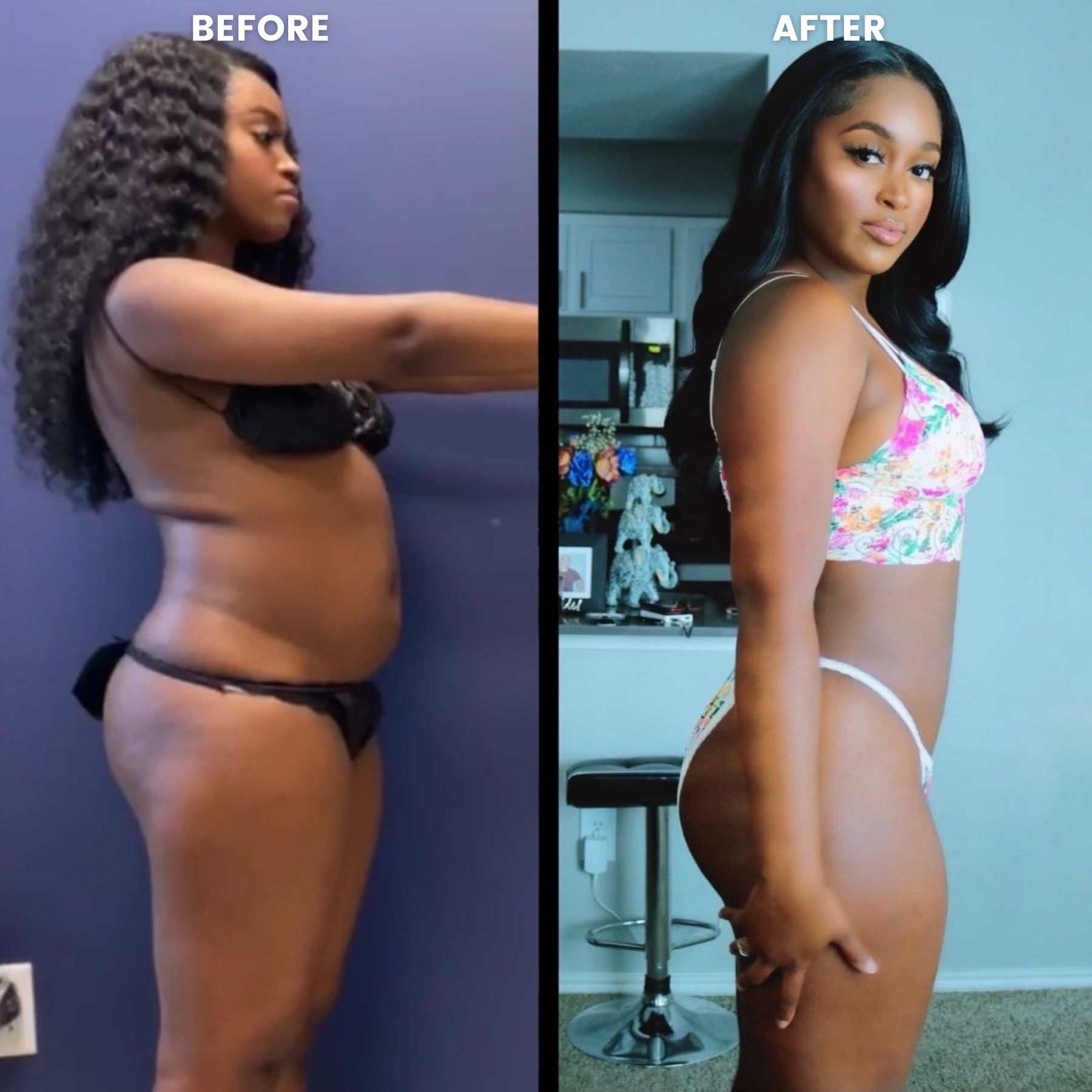 Taylor's Dallas Liposuction Transformation
