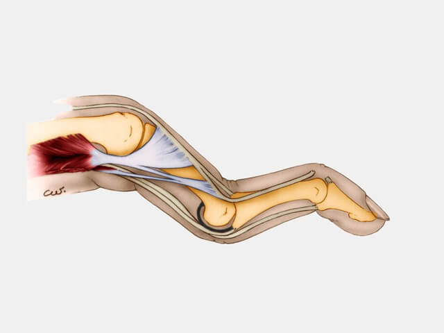 Lésion des tendons extenseurs Pathologies Institut Européen de la Main