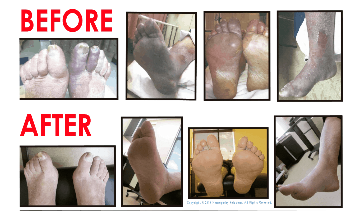 Peripheral Neuropathy Soul Focus Wellness Center of Redbank in Monmouth County, NJ