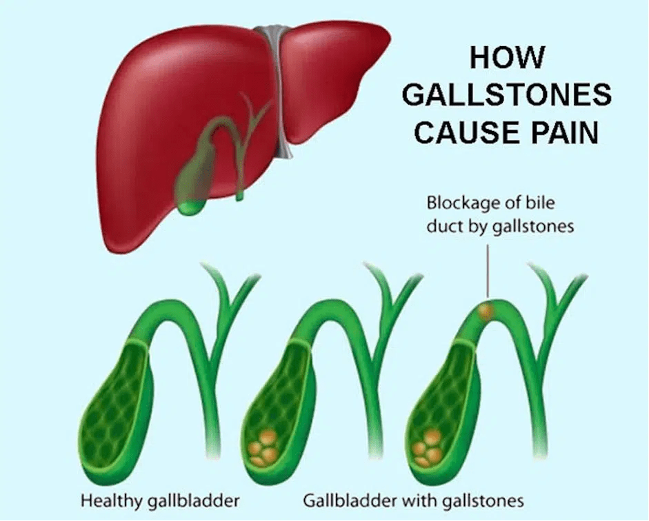 The Top 5 Supplements for Supporting Gallbladder Health