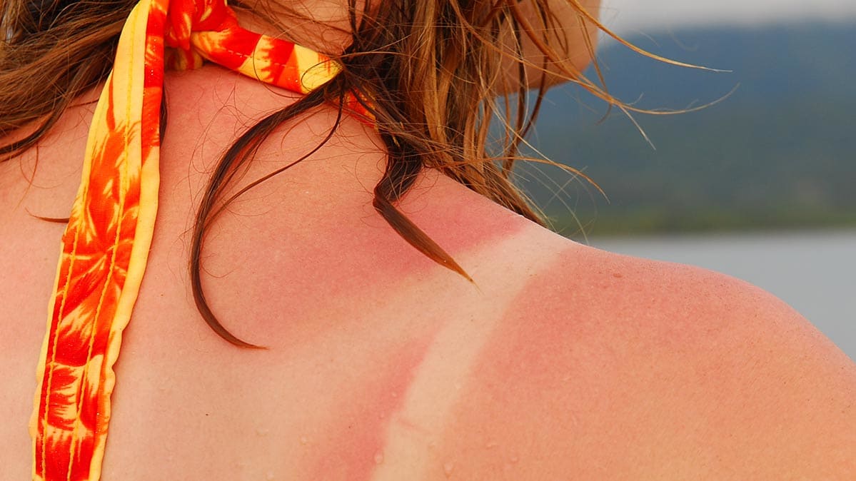 natural sunburn remedies by SIS Spa in Spain