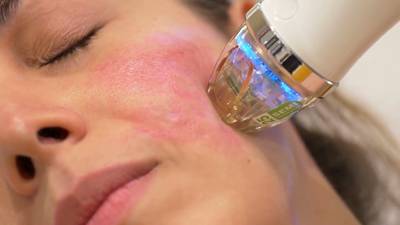 Radiofrecuencia fraccionada SpaMedica