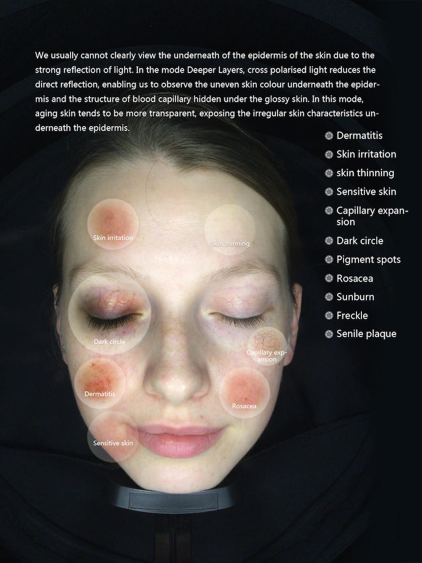 Skin Analysis Spamosman