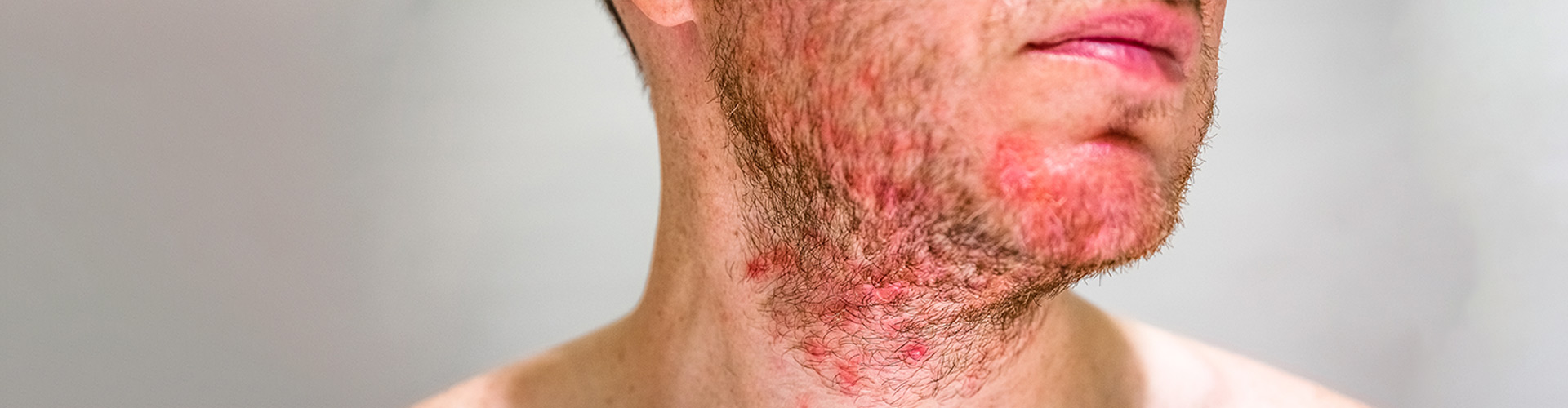 Alpharetta GA Seborrheic Dermatitis Treatment, Causes, Symptoms Johns