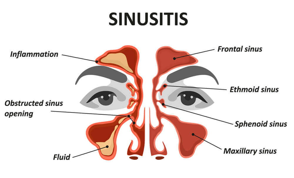 Sinus Elgin Sinusitis Barrington Specialty Care Institute