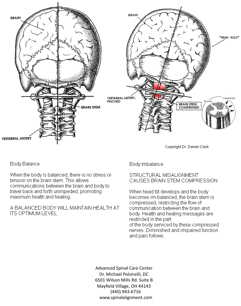The Atlas Misalignment Advanced Spinal Care Center