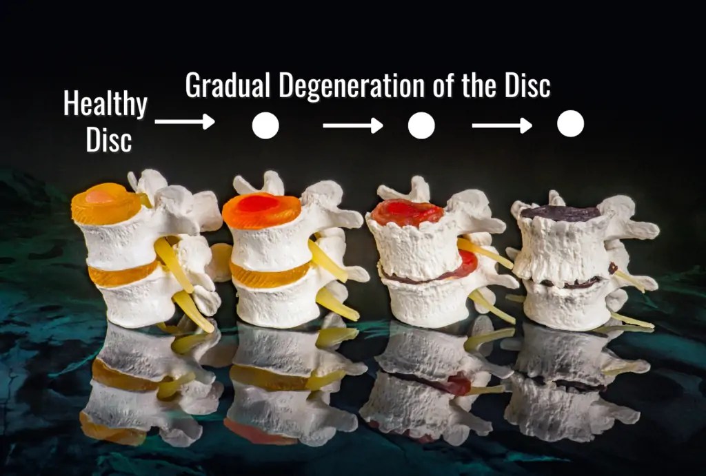 What Is Degenerative Disc Disease?