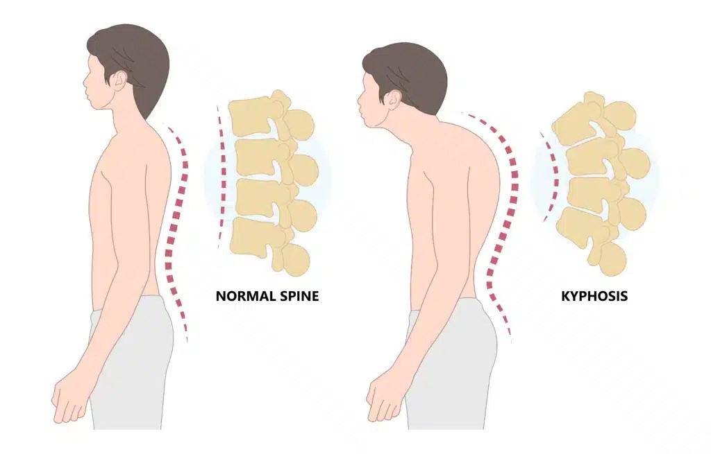 Kyphosis Definition Spine Info