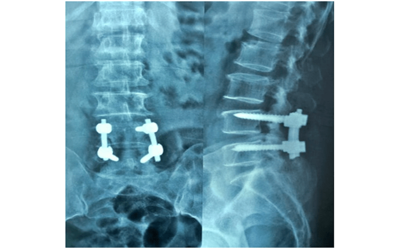 Posterior Micro Lumbar and Fusion for Degenerative