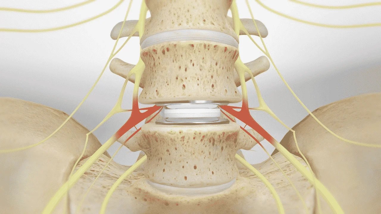 Lumbar Spinal Fusion Surgery VS Artificial Disc Replacement Spine Surgeon