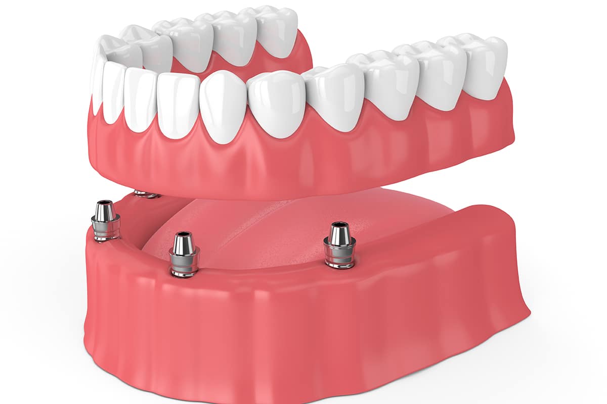 Benefits of Permanent Dentures General Dental Services TX