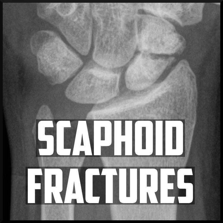 Scaphoid Fractures Diagnosis and Management Sports Medicine Review